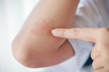 close-up of skin asian woman with acute psoriasis on her elbows. autoimmune incurable dermatological