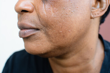 Brown skin woman with dark spots and sun burns with a brown background, hyperpigmentation on brown skin, african american woman with skin blemishes, damaged skin