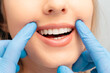 © Proxima Studio - Teeth whitening procedure. Dental care.
