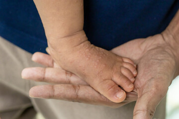 Close-up of a child's feet infected with hand-foot-mouth disease or HFMD originating from enterovirus or coxsackie virus, care for hand foot mouth disease