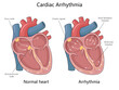 © Oleksandr Pokusai - normal heart with cardiac arrhythmia, showing sinus node, chaotic signals, and atrial fibrillation diagram hand drawn schematic raster illustration. Medical science educational illustration