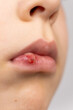 © Zarina Lukash - Skin damage, wound, abrasion on the lip of a small child.