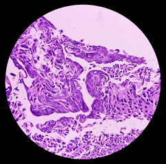 Poster - Urinary bladder cancer. Transitional cell carcinoma. show malignant neoplasm, 40x view.	
