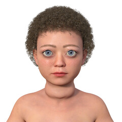 Sticker - A child with Graves disease, 3D illustration