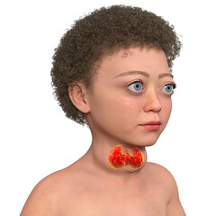 Sticker - A child with Graves disease, 3D illustration