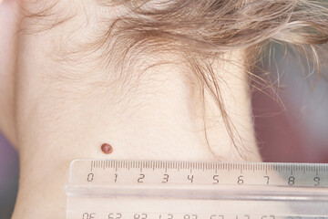 woman examing her abnormal mole. dermatology procedure. doctor checking patient skin cancer melanoma