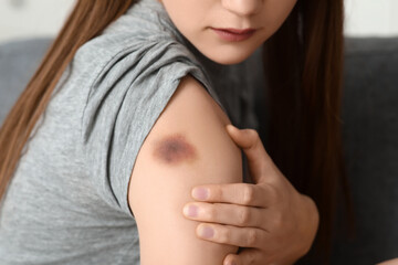 Canvas Print - Young woman with bruise on her shoulder at home, closeup