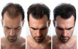 © Cantarela - Collage of 3 photos a man with a hair loss problem before and after treatment, anti-hair loss procedures, hair transplant, on a white background, collage. Appointment with a trichologist.