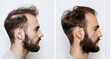 © Cantarela - Collage of two photos of a man with a beard hair loss problem before and after treatment, anti-hair loss procedures, hair transplant, on a white background, collage. Visit to a trichologist.
