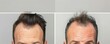 © Dalibor - Side-by-side comparison of a man's hair before and after treatment for thinning.