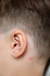 © Hanna - Red pimple. Concept of allergic reaction by mosquito bites. Ear close-up. Head of child with irritated swollen skin from insect bite. Body care. A strong itch. Vertical photo