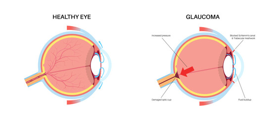 Canvas Print - Glaucoma eye disease