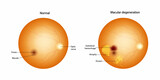 Normal retina and Macular degeneration: Drusen, Atrophy, Subretinal hemorrhage. 