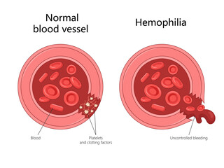 Wall Mural - comparing a normal blood vessel with one affected by hemophilia, differences in clotting and bleeding diagram hand drawn schematic vector illustration. Medical science educational illustration