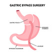 © Orapun - Gastric bypass gastroplasty operation. Obesity problem, weight loss procedure.