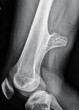 © Susmit - Xray image of a osteochondroma, a benign bone tumour