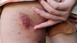© Rung Kh - The hand with blood, rash hives allergy and inflammation skin, reaction and urticaria, scar and dark spots on the leg of the woman, health care and medical concept.