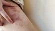 © Rung Kh - close up of a patient, rash hives allergy and inflammation skin, reaction and urticaria, scar and disease on the leg of the woman, health care and medical concept.