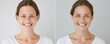 © WE.ARE.AI - Before and after results of Platelet-Rich Plasma facial treatment, Skin transformation, Visible improvement