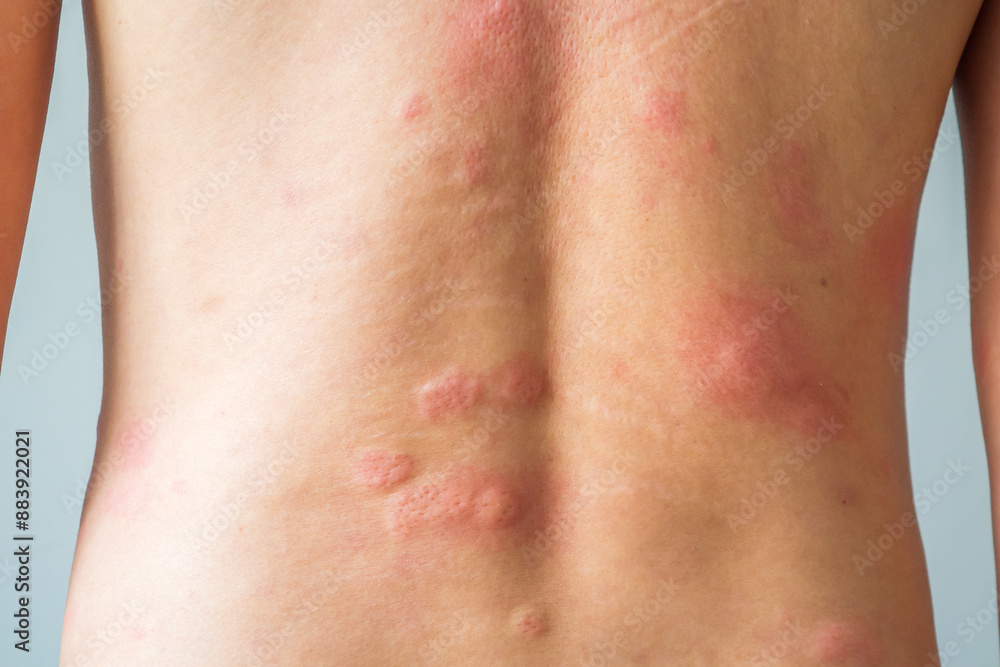 Young asian man itching and scratching on his back from allergic itchy dry skin eczema dermatitis insect bites