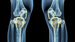 © Anastasiia Havelia - X-ray of knee joint, focusing on the knees and legs in blue color. Two images side by side on an isolated black background. Close-up of an x-ray showing anatomical details of the k