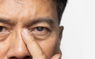 Senior man has cataracts. Generally, cataracts are common in older people.