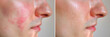 © Pixel Vest - Rosacea & Skin Conditions : Men's Faces, Before After Treatment. Close-up of Couperose, Vascular Stars, Capillaries, Freckles, Back Rashes. Dermatology Insights