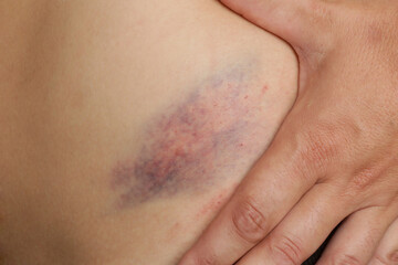 Wall Mural - close up view of a nasty bruise