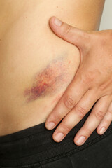 Wall Mural - close up view of a nasty bruise