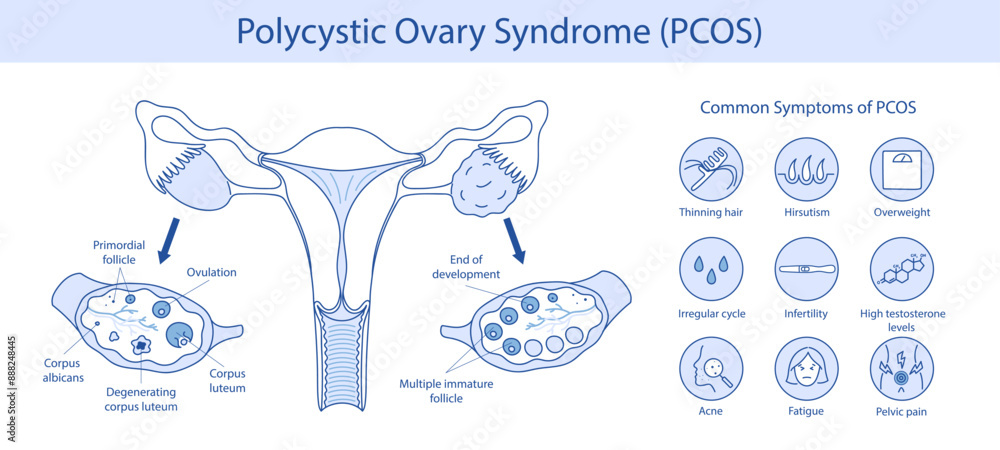 Polycystic ovary syndrome PCOS. Ovarian cysts of the female ...