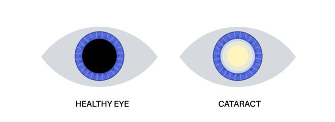 Sticker - Cataract eye disease