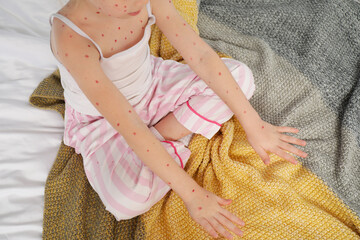 Canvas Print - Little girl ill with chickenpox sitting in bedroom, closeup