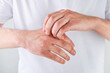 © kasia2003 - Man scratches or shows hands with dry, cracked skin on white backgrounds. Problem with many people - eczema on hand, allergies or dry skin. Health care concept. Close up.