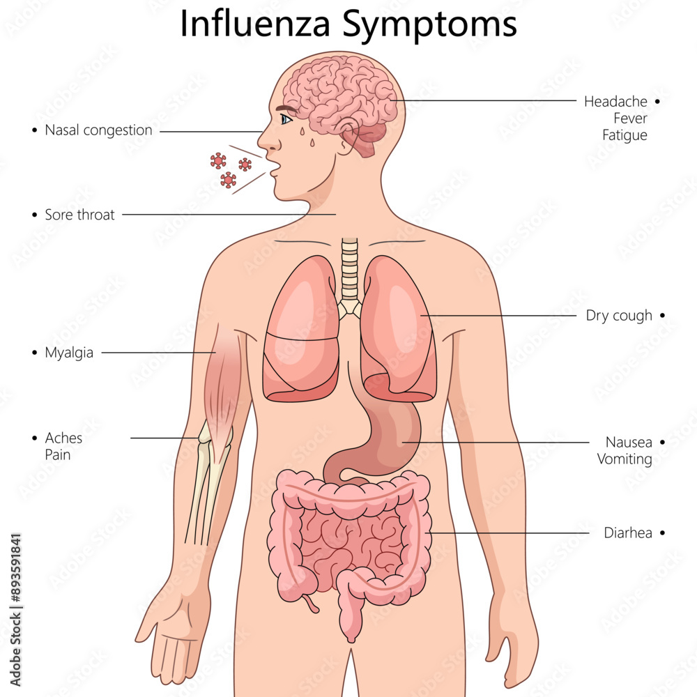 vector-de-stock-symptoms-of-influenza-in-different-parts-of-the-human