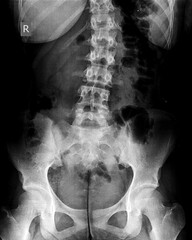 X-ray of idiopathic scoliosis of lumbar spine. Part of adolescent skeleton with spinal curvature on black background. Lateral backbone bending. Radiological anatomy image of lower back and pelvis. 