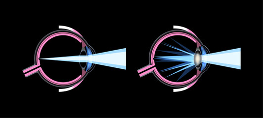 Sticker - Cataract eye disease