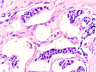 Poster - Breast biopsy photomicrograph of infiltrating duct cell carcinoma (NOS), grade-1