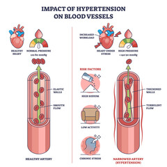 Poster - Impact of hypertension on blood vessels with high pressure outline diagram, transparent background. Labeled educational scheme with healthy vs narrowed artery and turbulent flow illustration.