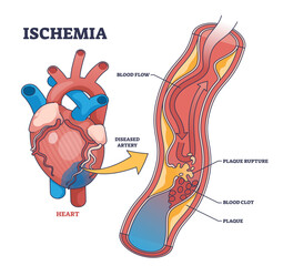 Poster - Ischemia as medical condition with blood flow blockage outline diagram, transparent background. Labeled educational anatomy scheme with plaque rupture, blood clot and restricted.