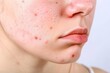 © AI Farm - Close-up of a young person's face with acne and pimples exhibiting skin issues and imperfections, highlighting dermatological concerns.