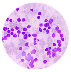 Poster - Bone marrow study smear picture of Acute Myeloid Leukemia, Blast cell, Granulopoiesis. Hematology. Blood cancer.