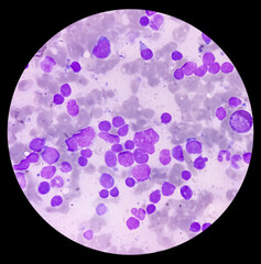 Poster - Bone marrow study smear picture of Acute Myeloid Leukemia, Blast cell, Granulopoiesis. Hematology. Blood cancer.