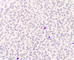 Poster - Anisocytosis anisochromia with both microcytic hypochromic and macrocytic hypochromic RBC with rouleaux formation, Dimorphic anemia. 