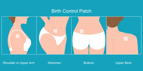 birth control patch.