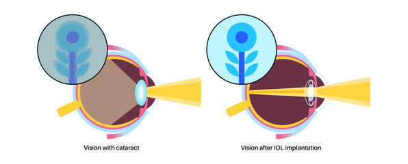 Poster - Intraocular lenses poster