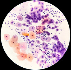 Canvas Print - Paps smear: NILM with reactive cellular changes associated with inflammation.