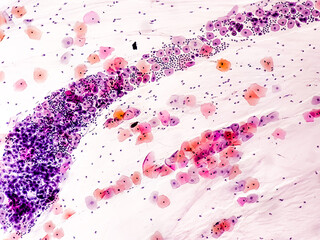 Wall Mural - Paps smear: NILM with reactive cellular changes associated with inflammation.