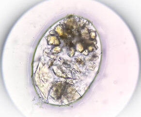 Sticker - Uric acid crystals and calcium oxalate monohydrate under microscope