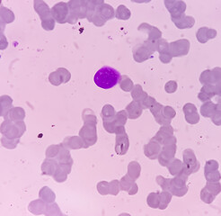 Wall Mural - Bone marrow study (BMS). Secondary metastasis  in bone marrow. Cancer cell. Oncology, cancerology, Bone marrow (BM) metastasis (BMM).