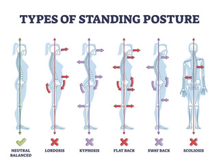 Canvas Print - Types of standing postures and medical back pathology set outline diagram, transparent background. Educational labeled collection.